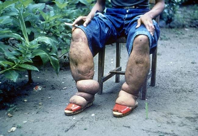 Metode Mengatasi Penyakit Kaki Gajah