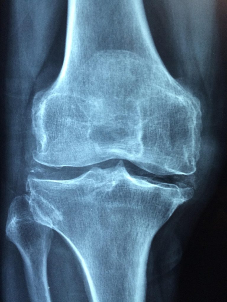 Penyebab Osteoporosis